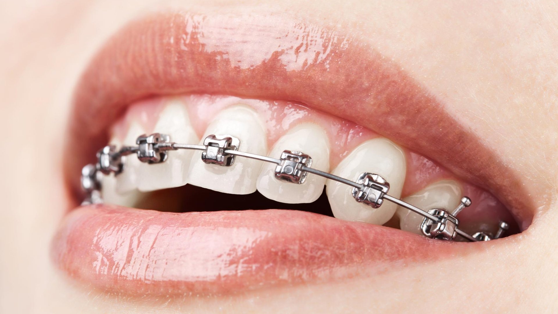 Molar Bands: High-Quality Orthodontic Solutions from OrthoExtent