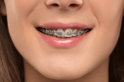 Self-Ligating Brackets