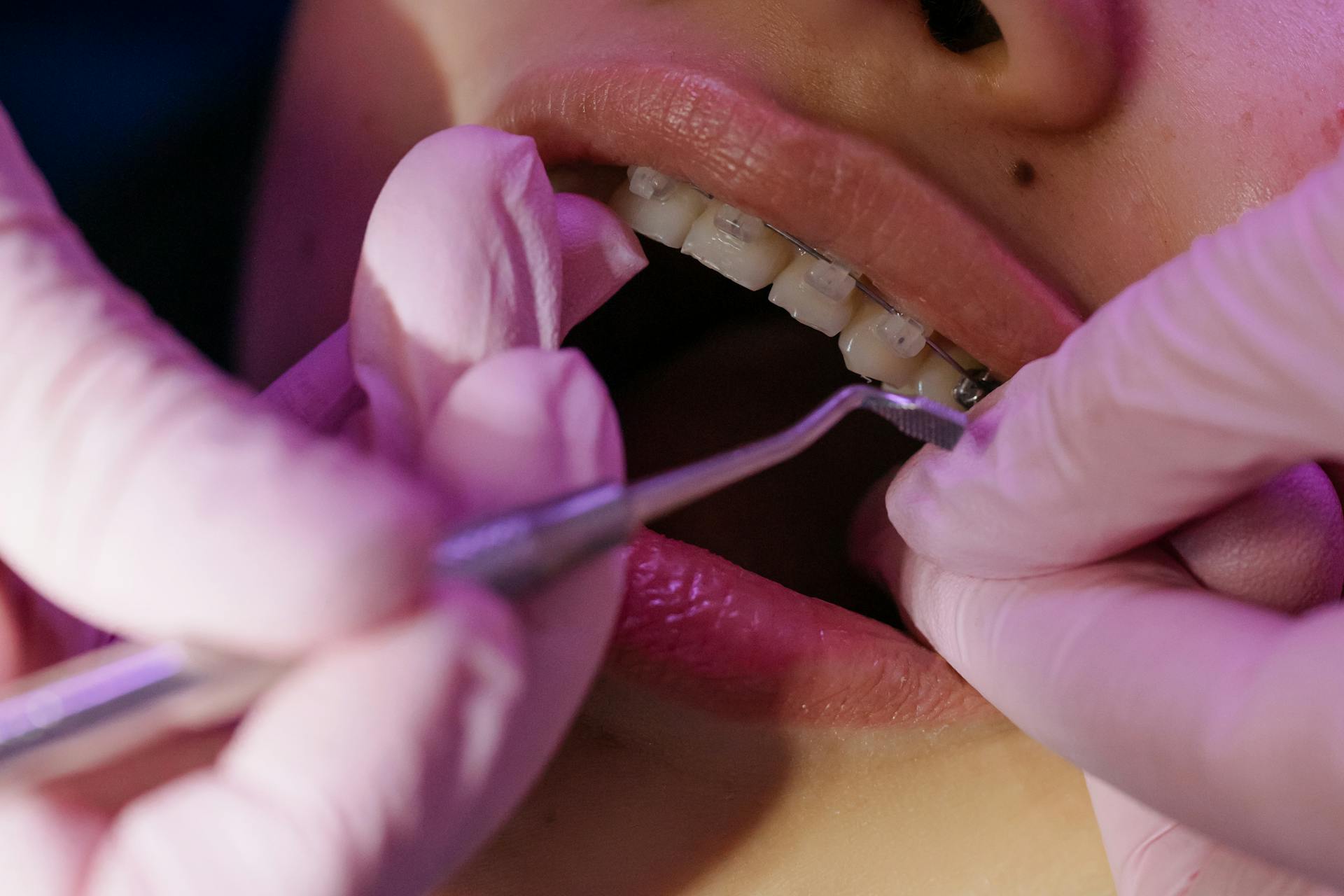 Best Orthodontic Brackets